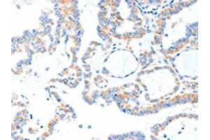 The image on the left is immunohistochemistry of paraffin-embedded Human thyroid cancer tissue using (TLR2 Antibody) at dilution 1/55, on the right is treated with fusion protein. (TLR2 antibody)