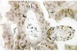 Immunohistochemistry analysis of MUTYH antibody in paraffin-embedded human colon carcinoma tissue. (MUTYH antibody)