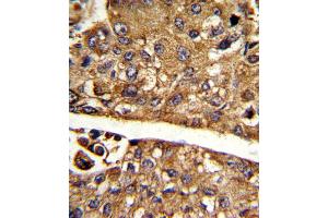 Formalin-fixed and paraffin-embedded human hepatocarcinoma reacted with MDH1 Antibody , which was peroxidase-conjugated to the secondary antibody, followed by DAB staining. (MDH1 antibody  (C-Term))