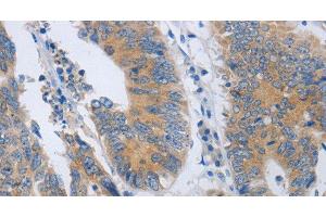 Immunohistochemistry of paraffin-embedded Human colon cancer using CD10 Polyclonal Antibody at dilution of 1:45 (MME antibody)