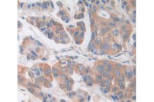 IHC-P analysis of breast cancer tissue, with DAB staining. (CDK18 antibody  (AA 144-425))