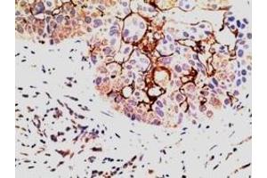 IHC testing of FFPE human breast carcinoma with EPS8 antibody at 5ug/ml. (EPS8 antibody)