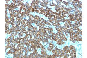 Formalin-fixed, paraffin-embedded human Skin stained with Cytokeratin, HMW Rabbit Recombinant Monoclonal Antibody (KRTH/1576R). (Recombinant Cytokeratin 2 antibody)