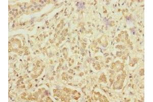 Immunohistochemistry of paraffin-embedded human pancreatic cancer using ABIN7167095 at dilution of 1:100 (RanBP3 antibody  (AA 1-250))