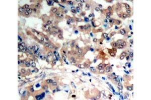 Immunohistochemistry of paraffin-embedded human lung carcinoma tissue, using Phospho-PRKAA1-T183/PRKAA2-T172 antibody (ABIN2988253). (PRKAA1 antibody  (pThr172, pThr183))