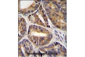 RN Antibody (C-term) (ABIN655838 and ABIN2845252) immunohistochemistry analysis in formalin fixed and paraffin embedded human prostate carcinoma tissue followed by peroxidase conjugation of the secondary antibody and DAB staining. (RNF215 antibody  (C-Term))