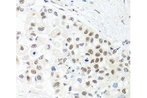 Immunohistochemistry of paraffin-embedded Human lung cancer using TRMT1 Polyclonal Antibody at dilution of 1:100 (40x lens). (TRMT1 antibody)
