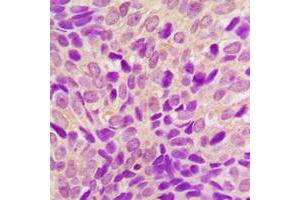 Immunohistochemical analysis of RSK4 staining in human breast cancer formalin fixed paraffin embedded tissue section. (RPS6KA6 antibody  (C-Term))