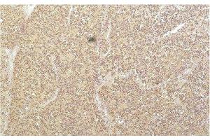 Immunohistochemistry of paraffin-embedded Human kidney carcinoma tissue using SGK1 Monoclonal Antibody at dilution of 1:200. (SGK1 antibody)