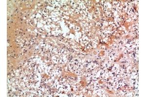 Immunohistochemical analysis of paraffin-embedded human-oophoroma, antibody was diluted at 1:100. (CMTM6 antibody  (C-Term))