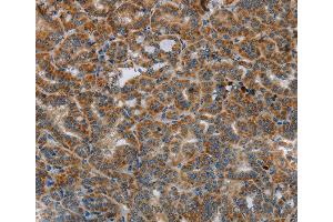 Immunohistochemistry of Human liver cancer using HSD17B14 Polyclonal Antibody at dilution of 1:40 (HSD17B14 antibody)