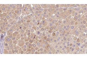 ABIN6272654 at 1/100 staining Human Melanoma tissue by IHC-P. (PSG3 antibody)