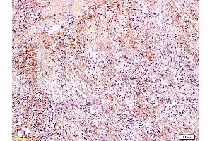 Formalin-fixed and paraffin embedded rat colon carcinoma labeled with Anti-Slc22A17 Y Polyclonal Antibody, Unconjugated (ABIN668691) at 1:300, followed by conjugation to the secondary antibody and DAB staining (SLC22A17 antibody  (AA 475-538))