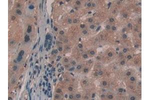 Detection of GaA in Human Liver cancer Tissue using Polyclonal Antibody to Glucosidase Alpha, Acid (GaA) (GAA antibody  (AA 595-770))