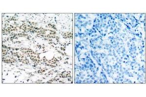 Immunohistochemical analysis of paraffin- embedded human breast carcinoma tissue using AFX (phospho-Ser197) antibody (E011137). (FOXO4 antibody  (pSer197))