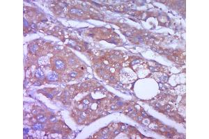 Paraformaldehyde-fixed, paraffin embedded human liver carcinoma; Antigen retrieval by boiling in sodium citrate buffer (pH6. (Vimentin antibody  (AA 101-200))