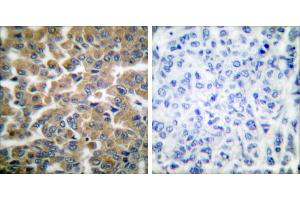 Peptide - +Immunohistochemical analysis of paraffin-embedded human breast carcinoma tissue using Bim antibody (#C0134). (BIM antibody)