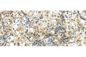 Immunohistochemistry of paraffin-embedded Human prostate cancer using WNT2 Polyclonal Antibody at dilution of 1/40 (WNT2 antibody)