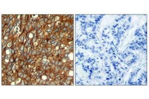 Immunohistochemical analysis of paraffin-embedded human breast carcinoma tissue using HER2 (Phospho-Tyr1248) Antibody (left) or the same antibody preincubated with blocking peptide (right). (ErbB2/Her2 antibody  (pTyr1248))