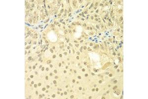 Immunohistochemistry of paraffin-embedded human oophoroma using TBL1XR1 antibody at dilution of 1:100 (x400 lens). (TBL1XR1 antibody)