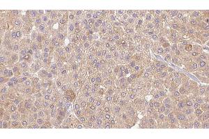 ABIN6273654 at 1/100 staining Human Melanoma tissue by IHC-P. (IL36A/IL1F6 antibody  (Internal Region))