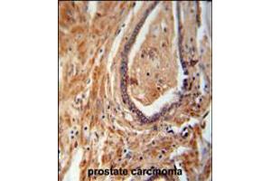 NDUFAF1 antibody immunohistochemistry analysis in formalin fixed and paraffin embedded human prostate carcinoma followed by peroxidase conjugation of the secondary antibody and DAB staining. (NDUFAF1 antibody  (C-Term))