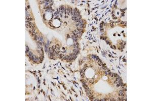 Immunohistochemistry of paraffin-embedded human rectal cancer tissue using H3K14me2 antibody at dilution of 1:200 (x400 lens) (Histone 3 antibody  (H3K14me2))