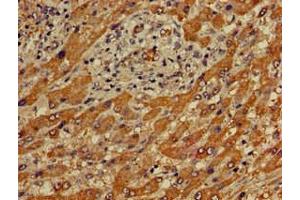 Immunohistochemistry of paraffin-embedded human liver cancer using ABIN7166683 at dilution of 1:100 (APOBEC4 antibody  (AA 221-367))