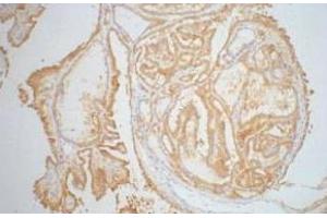 Immunohistochemistry of paraffin-embedded Human thyroid tissue using Galectin 3 Monoclonal Antibody at dilution of 1:200. (Galectin 3 antibody)