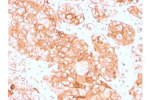 Formalin-fixed, paraffin-embedded human testicular carcinoma stained with Prolactin Receptor Recombinant Rabbit Monoclonal (PRLR3785R). (Recombinant Prolactin Receptor antibody)