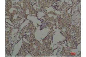 Immunohistochemical analysis of paraffin-embedded Human Breast Caricnoma using c-FosMouse mAb diluted at 1:200. (c-FOS antibody)