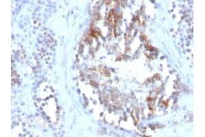 Formalin-fixed, paraffin-embedded human Testicular Carcinoma stained with SHBG Monoclonal Antibody (SPM605) (SHBG antibody)