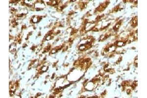 Formalin-fixed, paraffin-embedded human rhabdomyosarcoma stained with pan Muscle Actin antibody (MSA/953) (Pan Muscle Actin antibody)