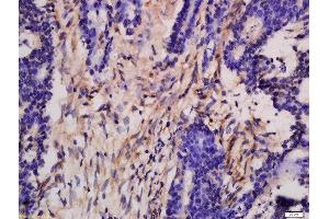 Formalin-fixed and paraffin embedded human colon carcinoma labeled with Rabbit Anti-DGKH Polyclonal Antibody, Unconjugated  at 1:200 followed by conjugation to the secondary antibody and DAB staining (DGKH antibody  (AA 51-150))