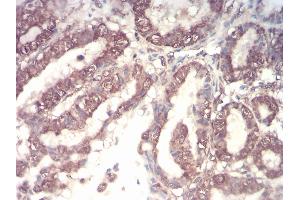 Immunohistochemical analysis of paraffin-embedded esophageal cancer tissues using CSF3 mouse mAb with DAB staining. (G-CSF antibody  (AA 1-207))