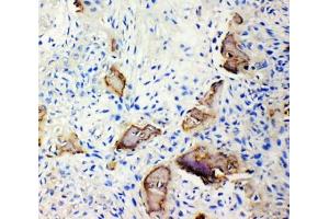 IHC-P: IBSP antibody testing of human osteosarcoma (IBSP antibody  (N-Term))