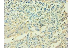 Immunohistochemistry of paraffin-embedded human cervical cancer using ABIN7156922 at dilution of 1:100 (IL-6 antibody  (AA 30-212))