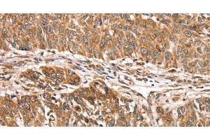 Immunohistochemistry of paraffin-embedded Human lung cancer using PDLIM4 Polyclonal Antibody at dilution of 1:30 (PDLIM4 antibody)