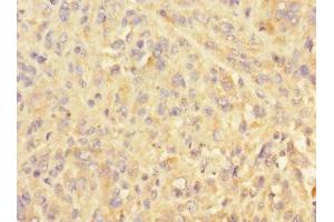 Immunohistochemistry of paraffin-embedded human melanoma using ABIN7151102 at dilution of 1:100 (Pellino 3 antibody  (AA 1-280))