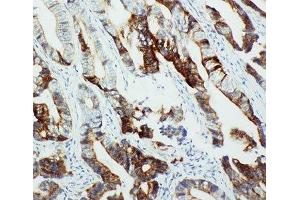 IHC-P: CYP2U1 antibody testing of human intestinal cancer tissue (CYP2U1 antibody  (C-Term))