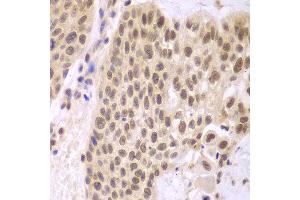 Immunohistochemistry of paraffin-embedded human lung cancer using CSNK2A2 antibody at dilution of 1:100 (400x lens). (CSNK2A2 antibody)