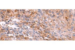 Immunohistochemistry of paraffin-embedded Human colorectal cancer tissue using PEMT Polyclonal Antibody at dilution of 1:55(x200) (PEMT antibody)