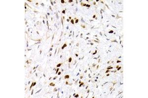 Immunohistochemistry of paraffin-embedded human gastric carcinoma using TP53 antibody at dilution of 1:200 (400x lens). (p53 antibody)