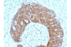 Formalin-fixed, paraffin-embedded human Ovarian Carcinoma stained with pS2 Mouse Monoclonal Antibody (SPM313). (TFF1 antibody  (AA 57-84))