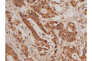 ABIN6267627 at 1/50 staining human colon cancer tissue sections by IHC-P. (FOXO1 antibody  (pSer319))