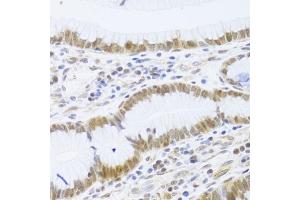 Immunohistochemistry of paraffin-embedded human gastric cancer using MCM4 Antibody (ABIN3017195, ABIN3017196, ABIN1680801 and ABIN6219991) at dilution of 1:100 (40x lens). (MCM4 antibody)