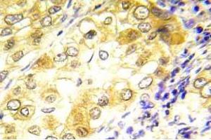 Immunohistochemistry (IHC) analyzes of P53 antibody in paraffin-embedded human lung carcinoma tissue. (p53 antibody)