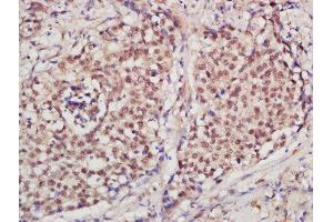 Formalin-fixed and paraffin embedded human laryngeal carcinoma  labeled with Rabbit Anti-PCNA [Proliferation Marker] Polyclonal Antibody (ABIN676598) at 1:200 followed by conjugation to the secondary antibody and DAB staining (PCNA antibody  (AA 201-261))