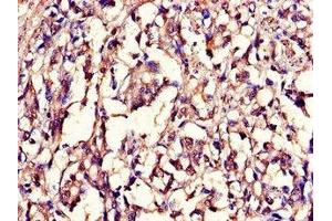 Immunohistochemistry of paraffin-embedded human gastric cancer using ABIN7157854 at dilution of 1:100 (Lamin B1 antibody  (AA 385-552))