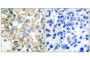 Immunohistochemical analysis of paraffin-embedded human breast carcinoma tissue, using FGFR1 Oncogene Partner antibody (ABIN5976395). (FGFR1OP antibody  (C-Term))